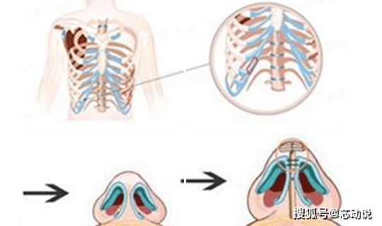 乾貨丨耳軟骨隆鼻和肋軟骨隆鼻有什麼區別?