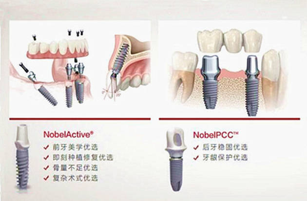 诺贝尔种植牙价格 Nobel