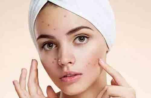 冰菊小课堂 鼻子长痘痘的原因有哪些 食物