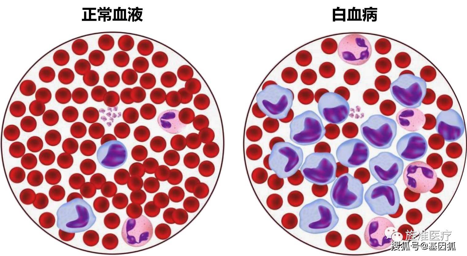 图191 浆细胞白血病血象-血液学细胞学-医学