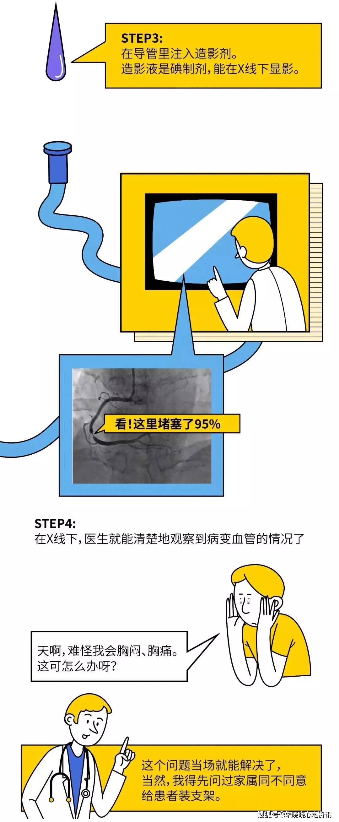 心脏支架是怎么装进去的?_冠脉