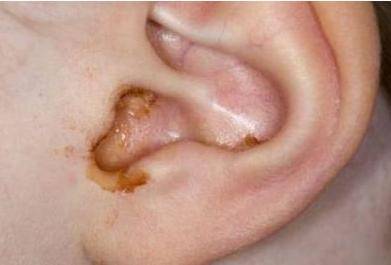 耳朵里的耳屎结痂图片图片