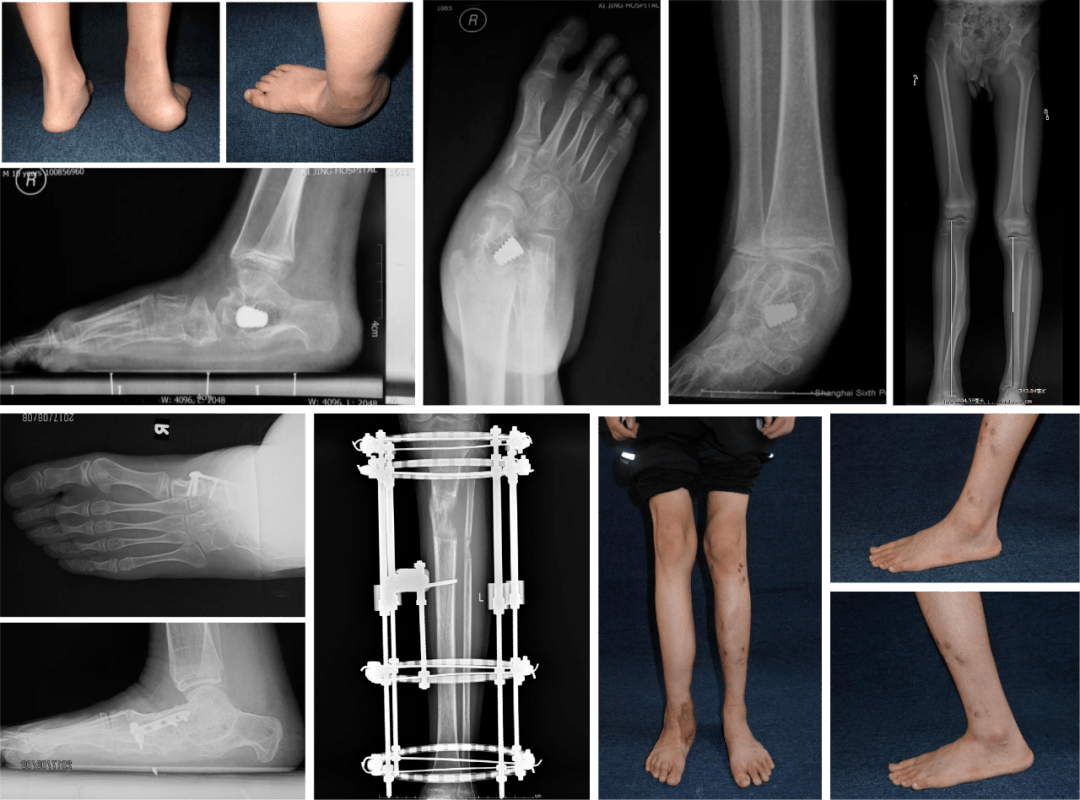 左側下肢短縮,患者無法行走;在我院行右側三關節融合聯合踝上截骨術