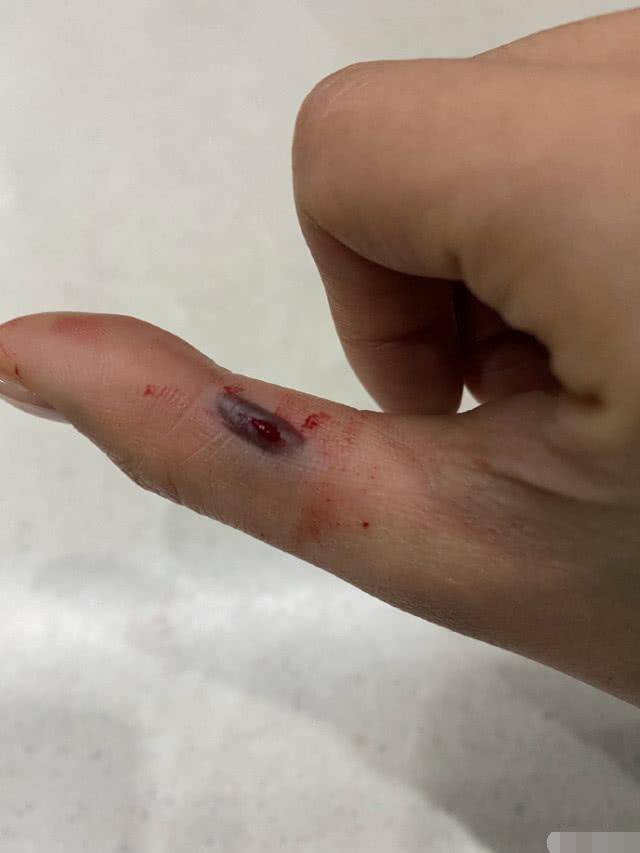沈梦辰工作受伤,拇指被夹出血包看着都吓人,网友喊话海涛送安慰