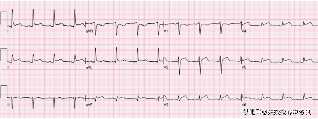 st段抬高不一定是心梗,这8张心电图必须鉴别!_束支