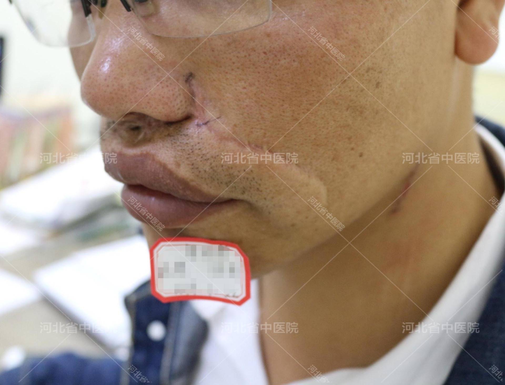 河北省中医院李秋霞主任凹陷疤痕如何治疗