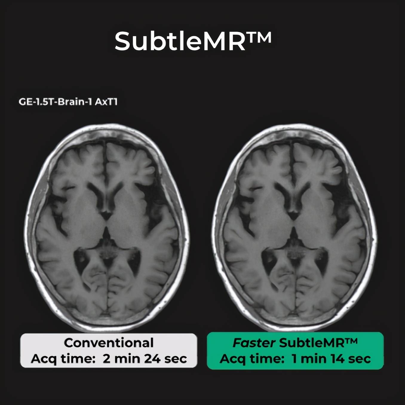 产品|深透医疗发布SubtleMR2.0，可优化全身MRI医学图像