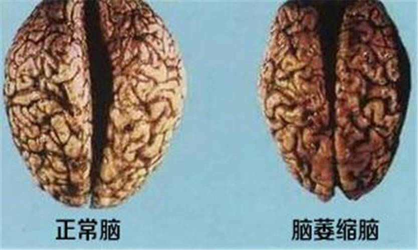 如何预防脑萎缩 17e8f71c522345a4af3212ebf88e8909.jpeg
