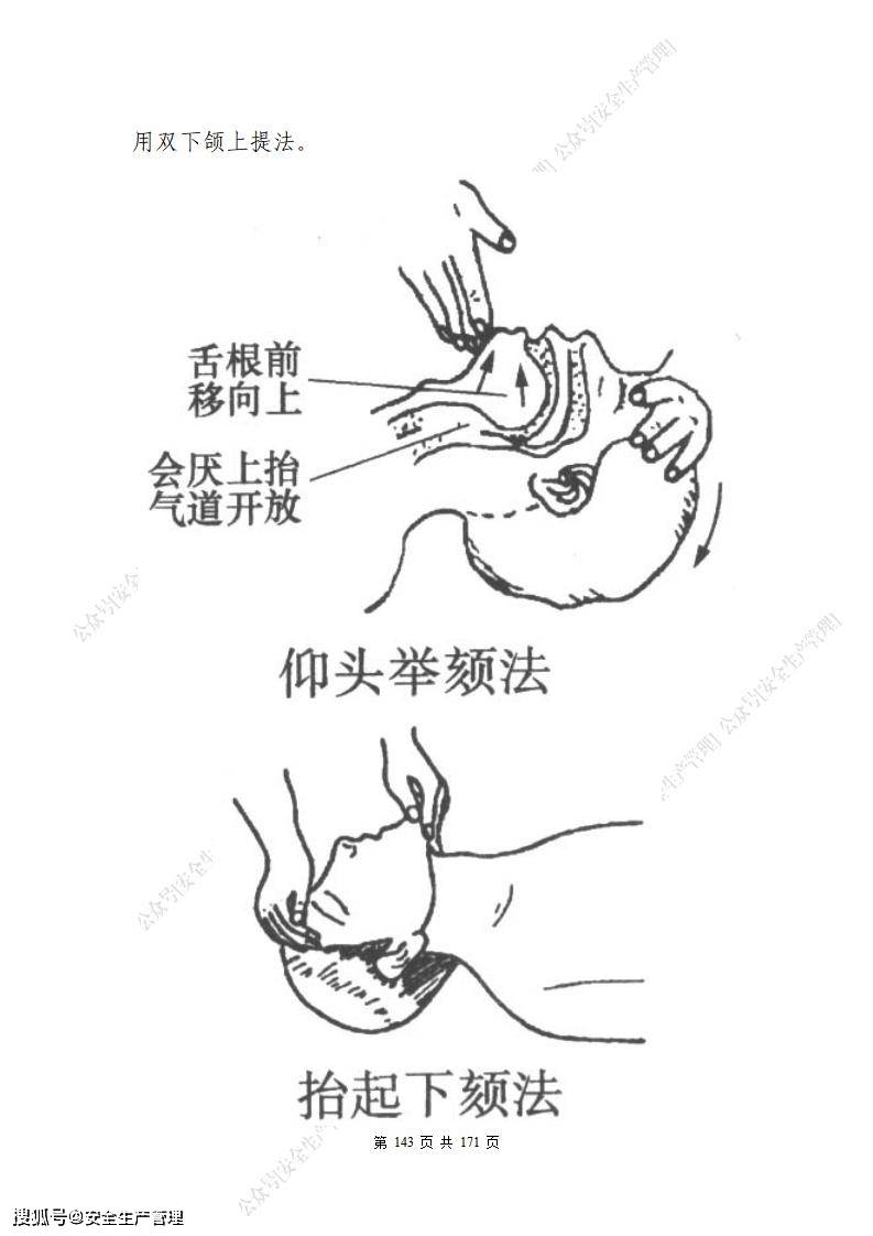 双下颌上提法图片