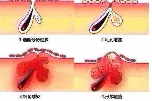 粉刺是怎么导致的 6cedd7affa2c42408a2202465f3e637c.jpeg