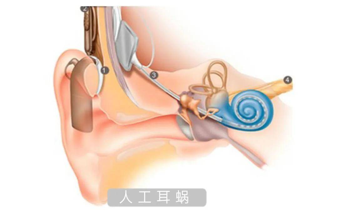 【人工耳蝸科普系列】人工耳蝸與助聽器有什麼區別,聽聽專家怎麼說