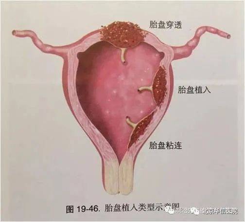 胎盘羊水子宫的结构图图片