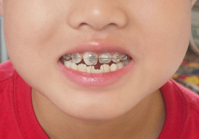 原创5岁女孩"牙缝"越来越大,宝妈想给娃戴牙套,你有同样的烦恼吗