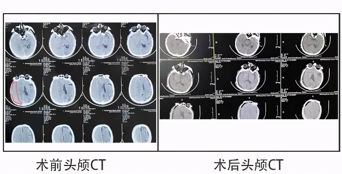 头颅ct片:患者右侧额颞顶部可见一新月形等密度影,同时伴有右侧侧脑室