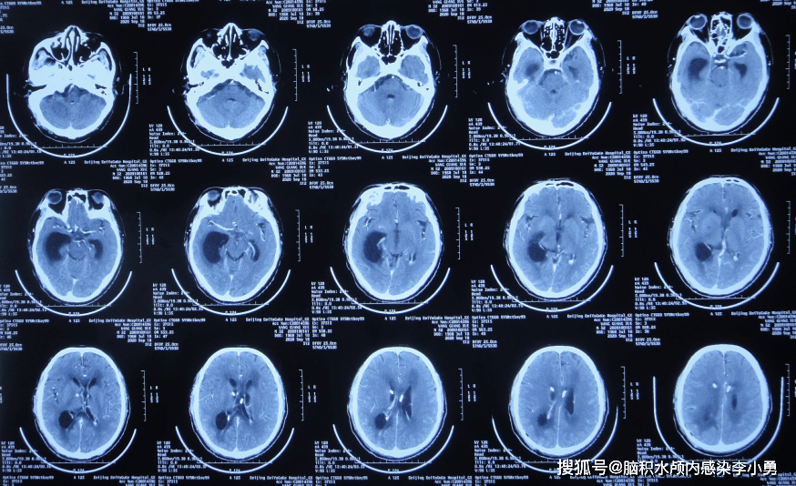 脑脓肿术后脑积水颅内感染致意识不清脑室粘连,7个月3家医院7次治疗仍