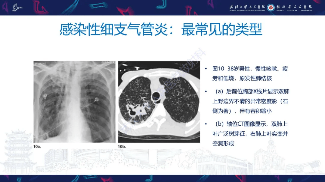 細支氣管炎影像診斷