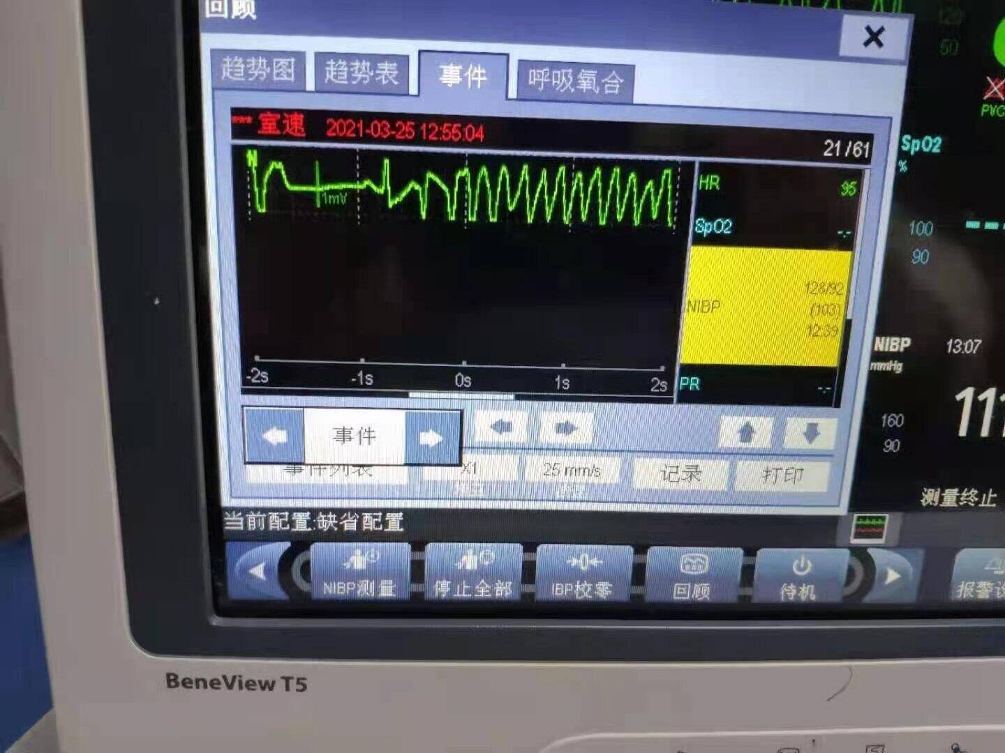 前降支中段完全闭塞,术中患者突发意识丧失,心电监护提示:室速,立即电