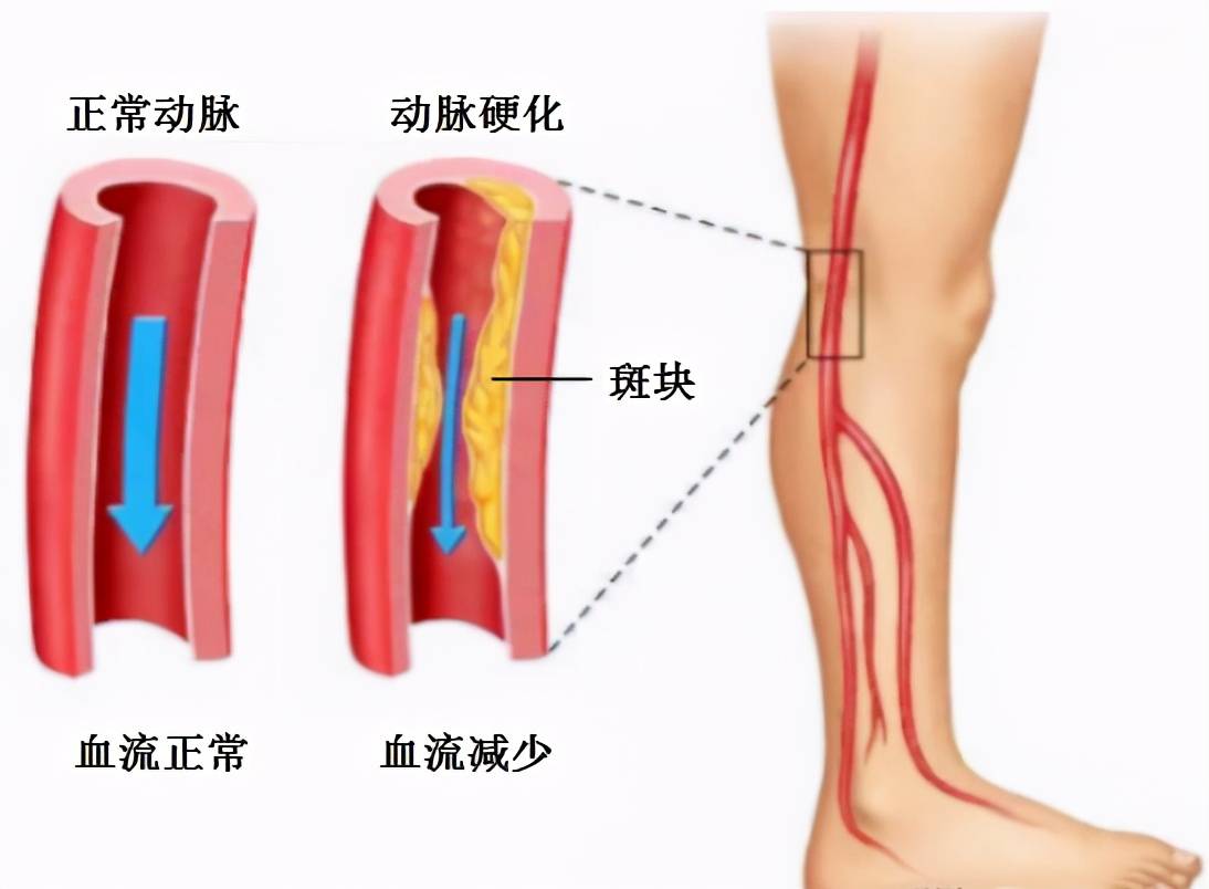 是指下肢动脉硬化造成血管堵塞,引起远端组织缺血,并产生一系列症状