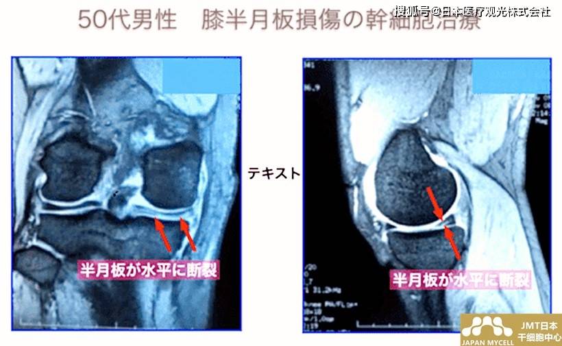 日本干细胞案例 50岁日本男性半月板损伤的干细胞治疗 进行
