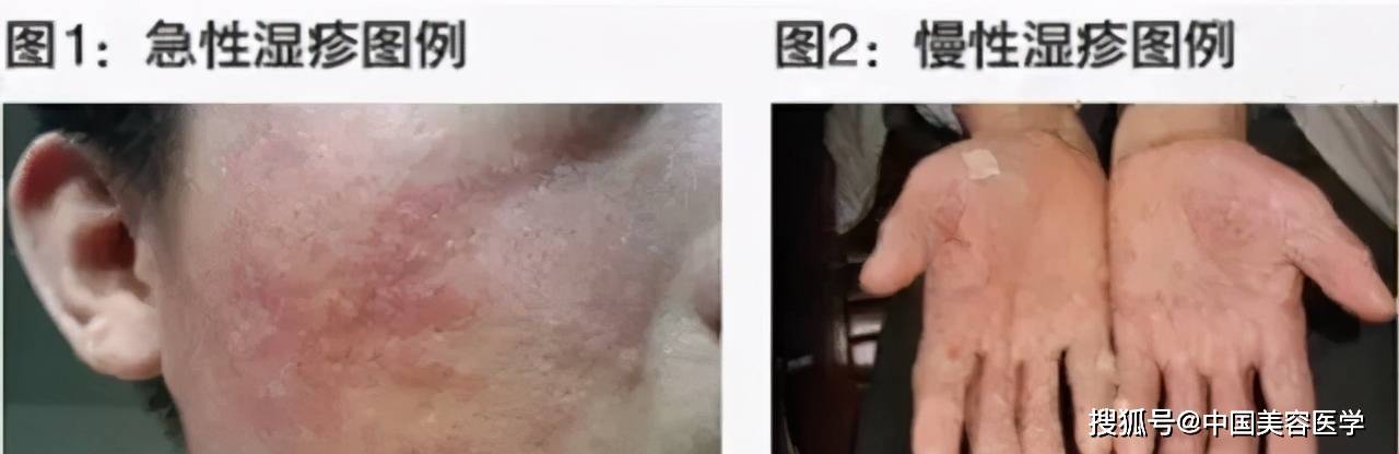 注意 9种过敏性皮肤病的诊断要点及用药方案 症状