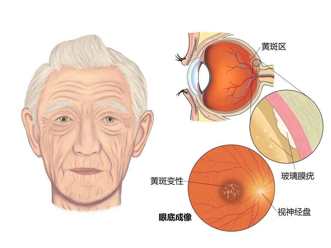 容小觑,发展至晚期能造成不可逆的视力损伤,那就是——老年性黄斑变性