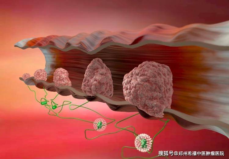 直肠癌术后大便增多，介入中医抗癌标本兼治_手机搜狐网