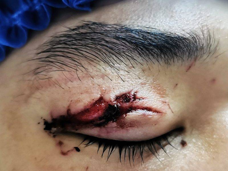 男子踢球竟险些毁容医生巧手绣花终复原