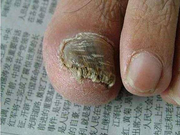 皮肤科普:灰指甲症状图片