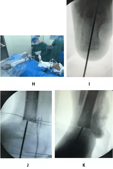 影像|西北首例！机器人辅助髓内钉踝关节融合联合外固定架骨延长术