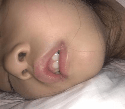 造成了孩子嘴唇向外翻,从而小孩子的嘴唇变大变厚
