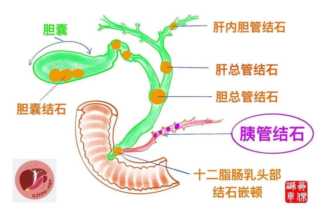 胰管结石烦恼多?内镜无痛巧取胰管结石了解一下!_激光