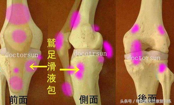 鵝掌肌腱炎過度勞動或是使用不當,都有可能引起滑膜的急性發炎,關節內