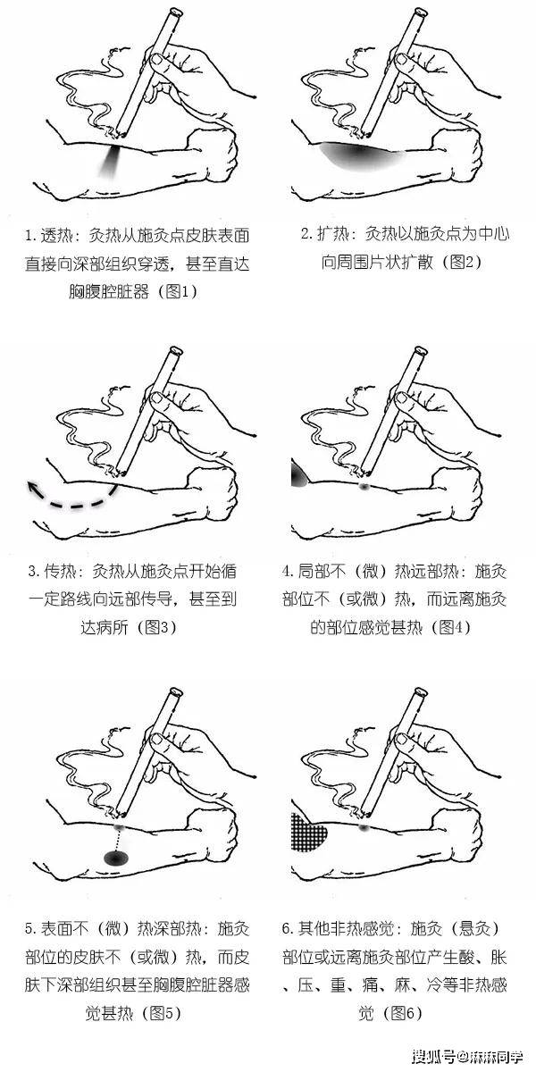 中医适宜技术神奇的热敏灸