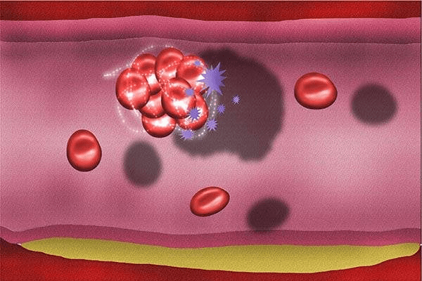原创血液粘滞度是什么哪些疾病会引起血液粘稠