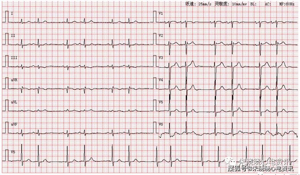 房性早搏二聯律 【 解析過程 】 1,如圖所示,p波在Ⅰ,Ⅱ,avf,v4-v6