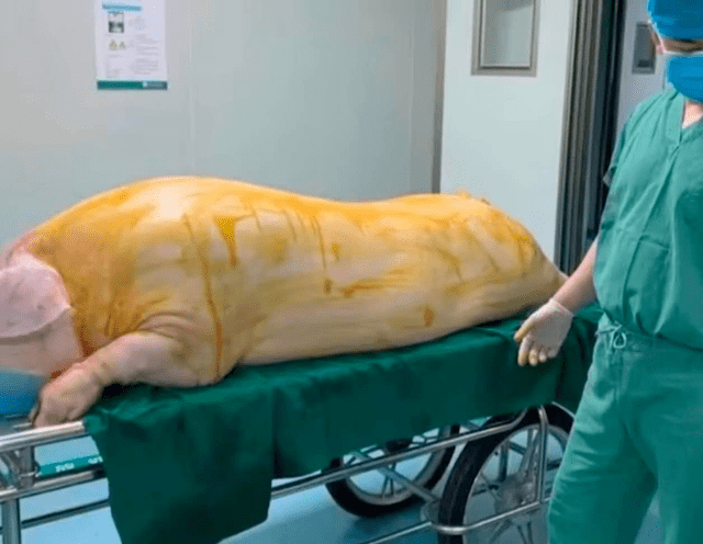 烧伤病人手术移植猪皮惹争议,医院回应_费用