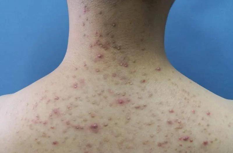 在多种因素影响下容易造成皮脂分泌过旺,毛囊堵塞,这些都是诱发痤疮