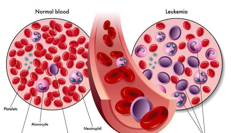 小淋巴细胞淋巴瘤症状 c4edf1affb75439e9e0d87855bc444a6.jpeg