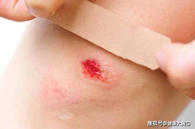 不同伤口应该怎么处理?