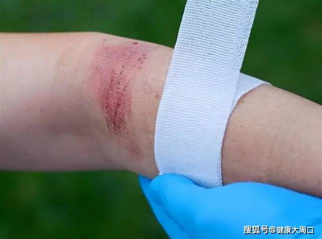 酒精,碘伏,碘酒,紫药水,有什么区别?不同伤口应该怎么处理?_消毒