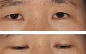上眼睑皮肤中外侧松弛下垂,外眦角被遮盖起来显得特别小,使得眼裂变成