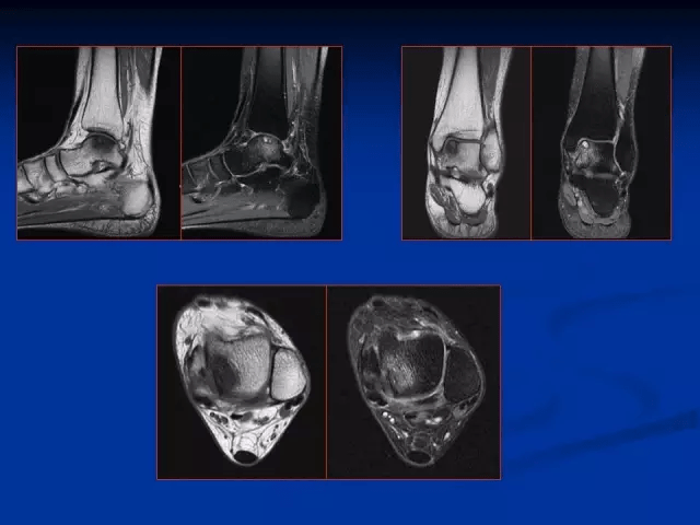 踝關節mri讀片要點