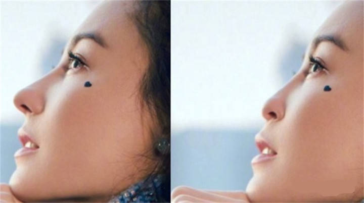 范芳医生谈东方女性鼻部美学标准 鼻子