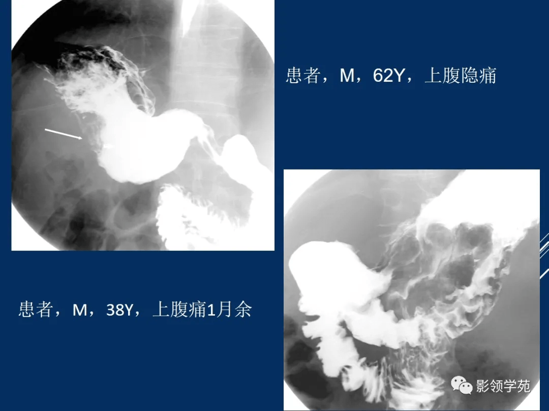 15個病例熟悉胃腸道間質瘤影像表現