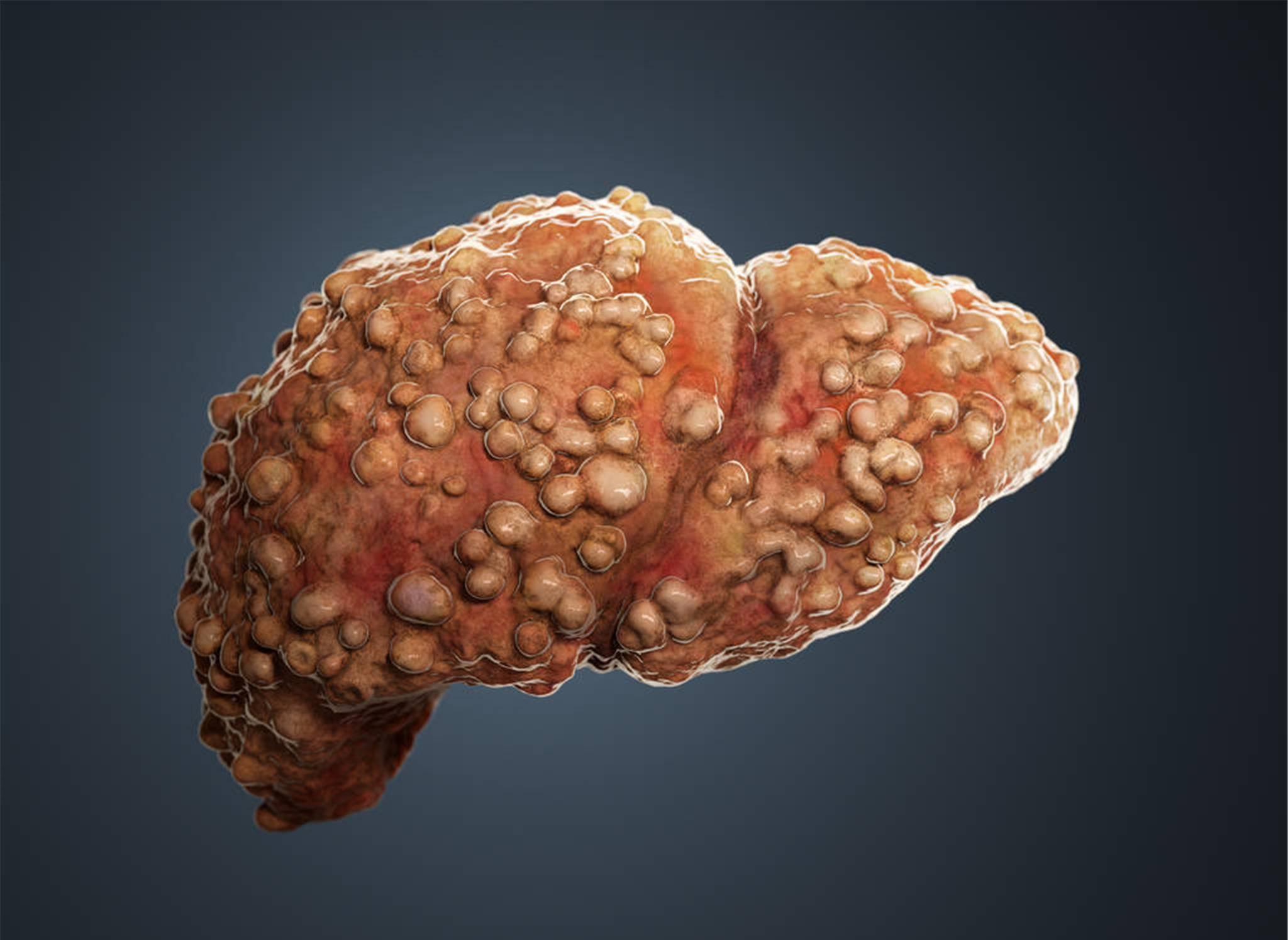 啥是自免肝 79c4825f17f5441f915e80c0c57ad3c0.jpeg