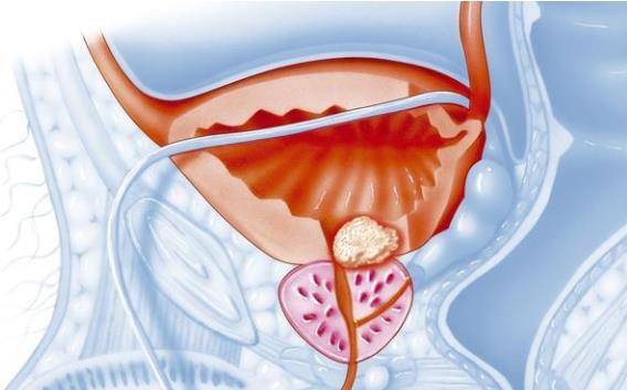 前列腺癌早期有哪些信號?知曉要點,還你一
