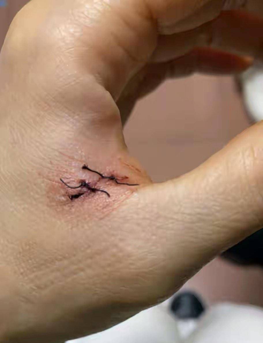 著名女星容祖儿手部割伤!紧急送往医院,自曝血液从伤口喷出_受伤