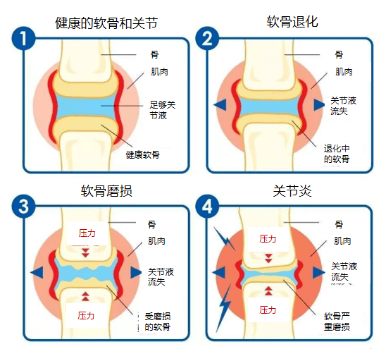 关节软骨的位置图片