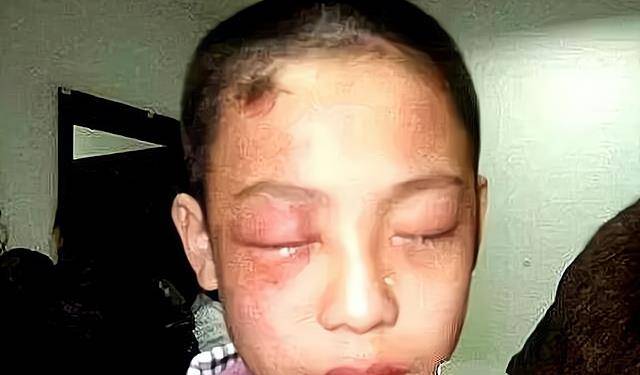 原创5岁男孩眼球被溶终身残疾这东西每家都有家长要警惕