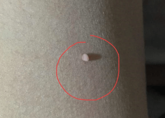 并且渐渐长成菜花,鸡冠状时,就有可能是hpv感染而生的湿疣